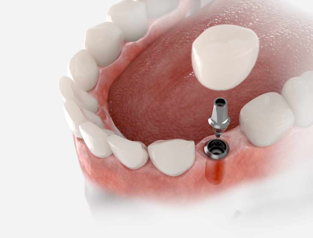 pérdida dental