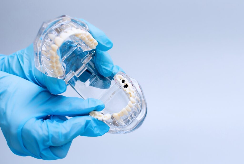 caries interproximales