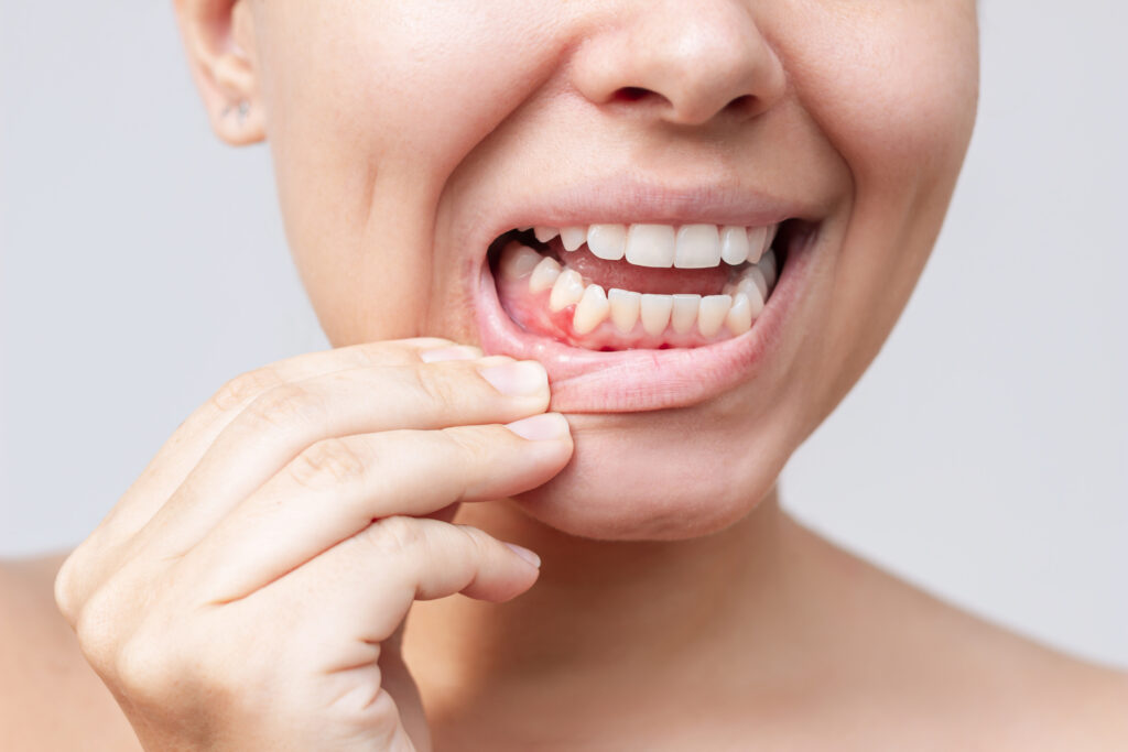 fases de la enfermedad periodontal