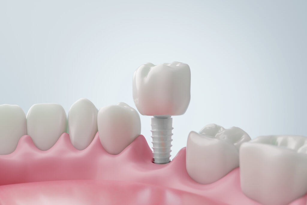 implantes