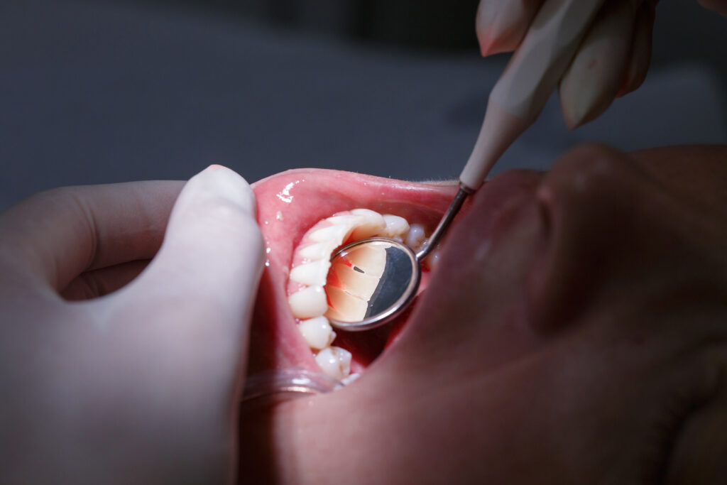 curetaje dental