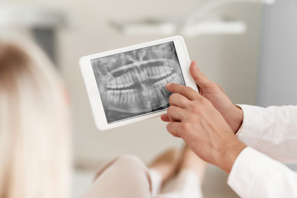 implantes dentales